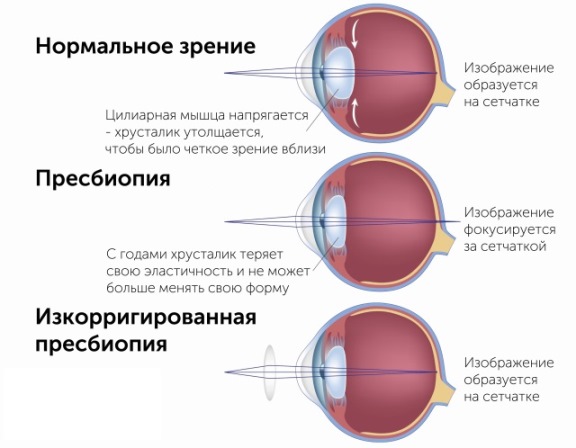 Лечение дальнозоркости в Екатеринбурге, операция лазерной коррекции глаз по доступной цене